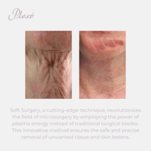 PLASMA THERAPY PLEXR®  IT MUST BE KISMET MEDICAL + AESTHETICS MEDICAL AESTHETICS | CLINICAL DERMATOLOGY | INJECTABLES | MICRONEEDLING | PDO THREADS | WOMENS HEALTH | WEIGHT LOSS | WELLNESS LOOMIS | GRANITE BAY| ROCKLIN | AUBURN | ROSEVILLE| FOLSOM | LINCOLN