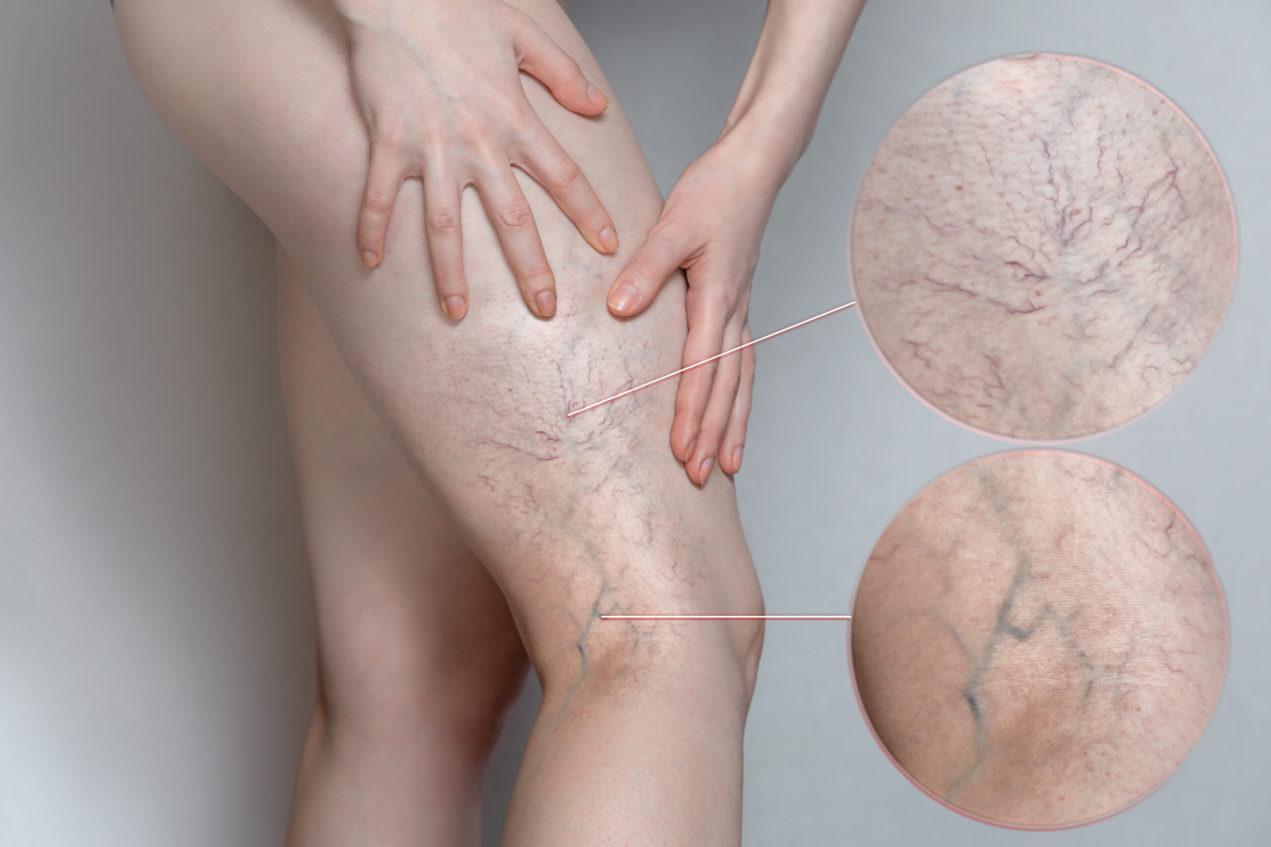 What is Sclerotherapy