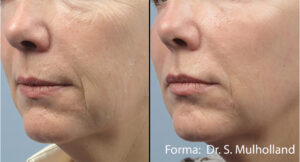 Forma RF for skin tightening