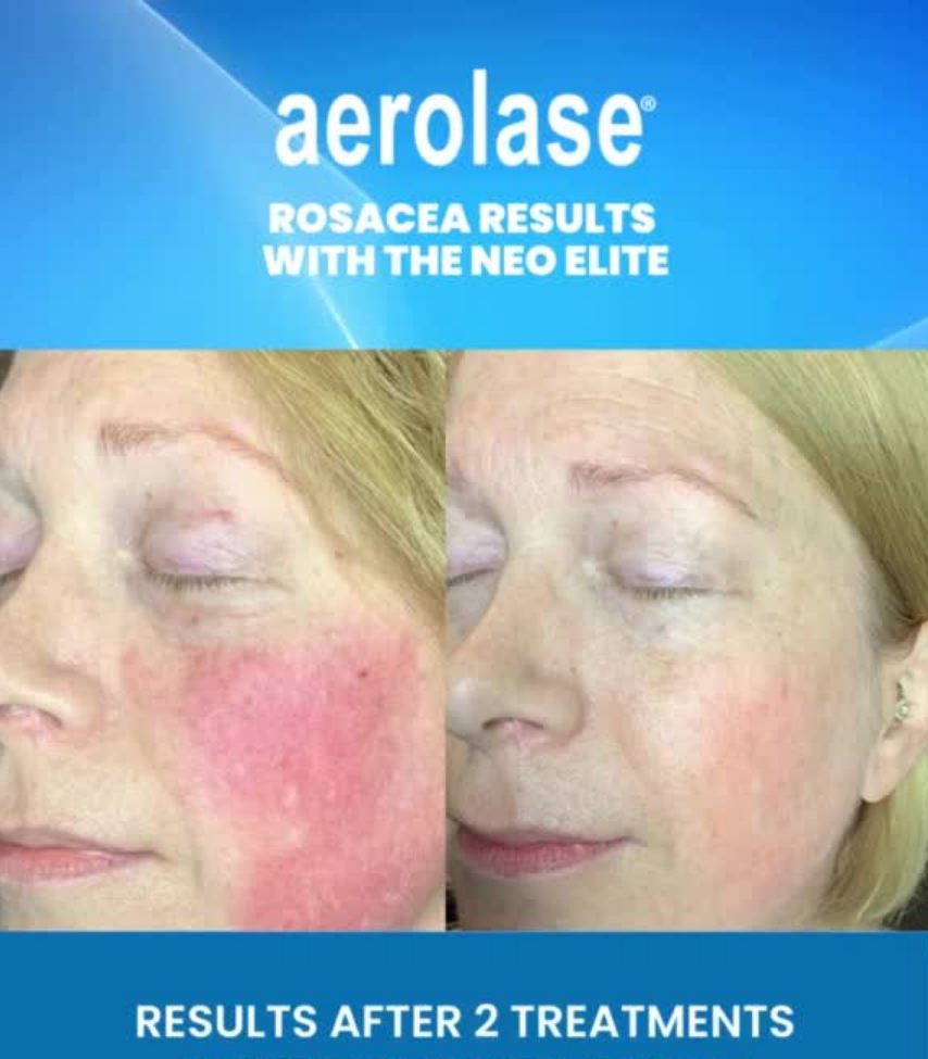 Rosacea Adult Acne | When Do We Start Losing Collagen? Loomis California | Granite Bay | Folsom | Roseville | Lincoln | Auburn | Skin Care
